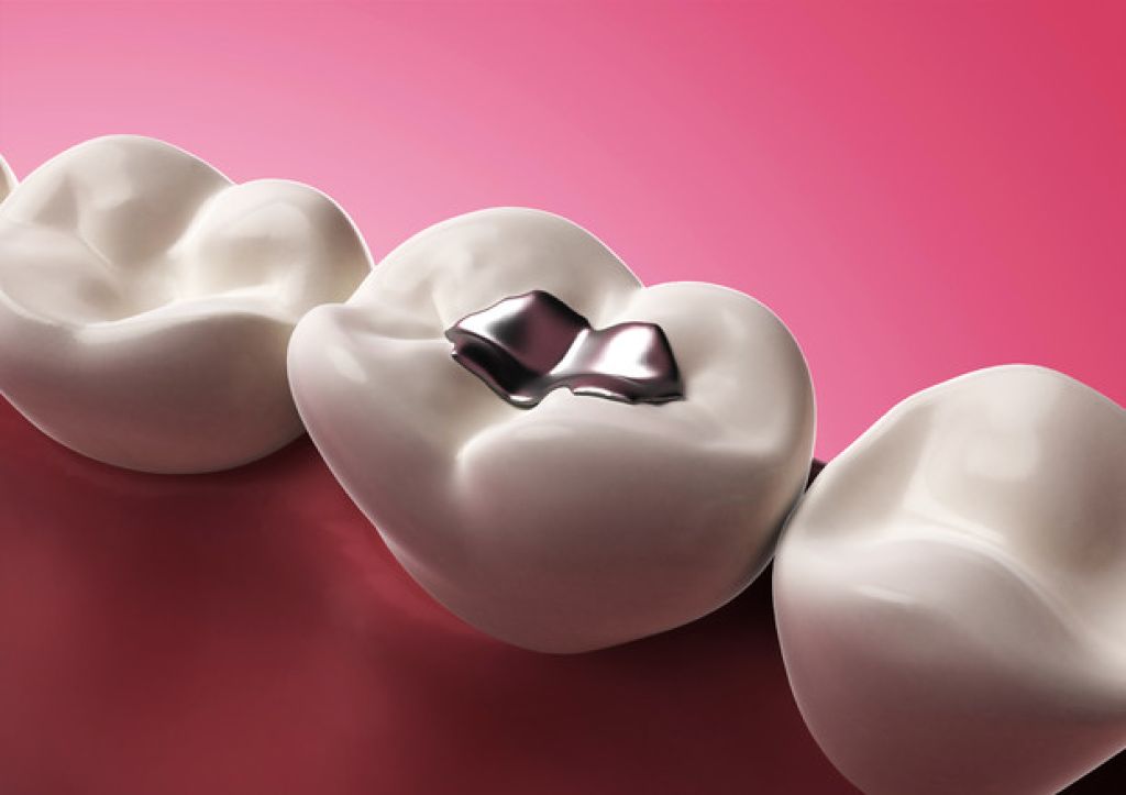 Emergenza mercurio: l&rsquo;Unione europea corre ai ripari limitando l'uso dell'amalgama